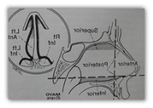 setto nasale deviato 3